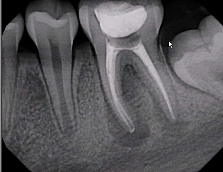 Digital Xrays Signature Endodontics Endodontist Saint Clair Shores, MI